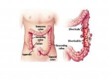 Colon Diverticulosis