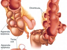 Colon Diverticulosis