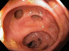 Colon Diverticulosis